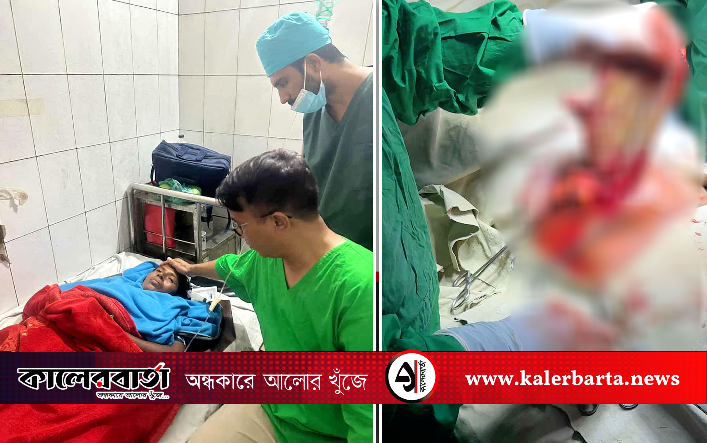 অপারেশনের দেড় বছর পেট থেকে বের হলো সার্জিক্যাল মপ