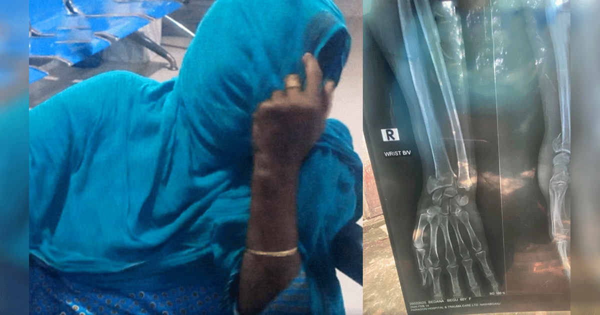 নবাবগঞ্জে তুচ্ছ ঘটনায় বৃদ্ধার হাত ভেঙে দিল প্রতিপক্ষ, থানায় অভিযোগ