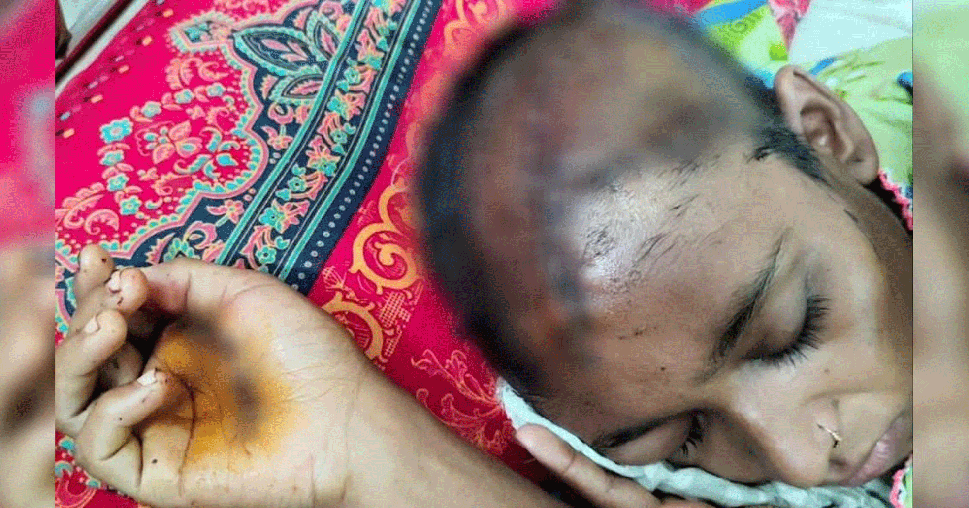 পলাশবাড়ীতে স্বামীর অমানুষিক নির্যাতন, শতাধিক সেলাই নিয়ে মৃত্যুর সঙ্গে পাঞ্জা লড়ছেন গৃহবধূ